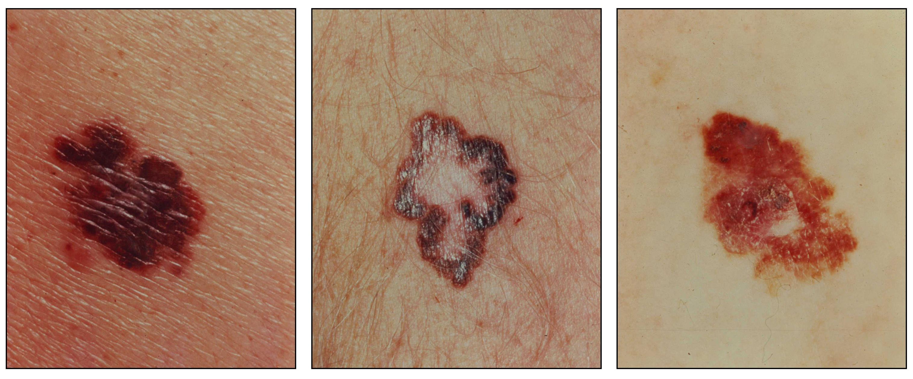 What Does Melanoma Look Like